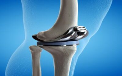 নি-রিপ্লেসমেন্ট (Knee Replacement): হাঁটুর ব্যথা থেকে মুক্তির আধুনিক চিকিৎসা